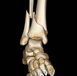 Ankle Fracture