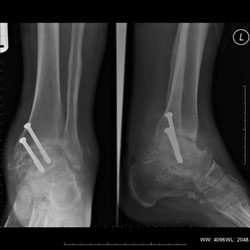 Ankle arthrodesis