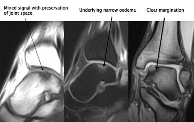 Osteochondral lesions of the talus 