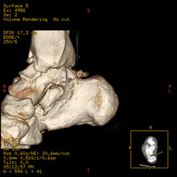 Osteophytes